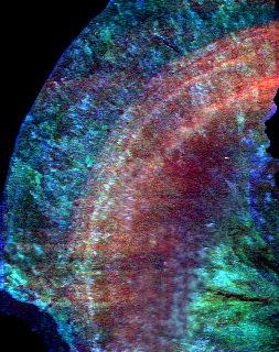 Цветное катодолюминесцентное изображение среза желчного камня человека. Наблюдается кольцеобразное распределение областей с повышенной концентрацией холестерина (синий), билирубина (красный) и белка(зеленый)Размер поля сканирования 4х5 мм.
